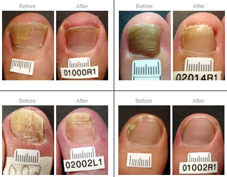 before and after toenail fungal 